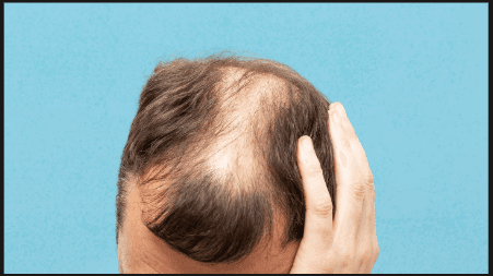 Hair loss consultation with pharmacist treatment advice